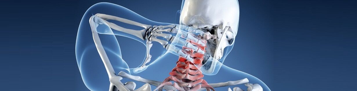 Az emberi nyaki gerinc osteochondrosis