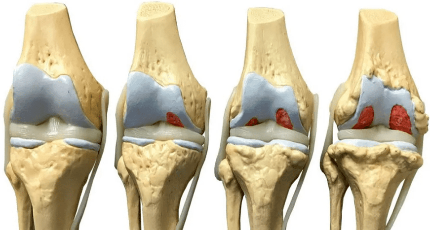 a térdízület károsodása az arthrosis kialakulásának különböző szakaszaiban