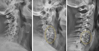 képek a nyaki gerincről a diagnózis érdekében