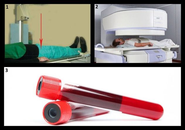 A coxarthrosis diagnosztizálásának módszerei - a csípőízület röntgen- és MRI-je, vérvizsgálat