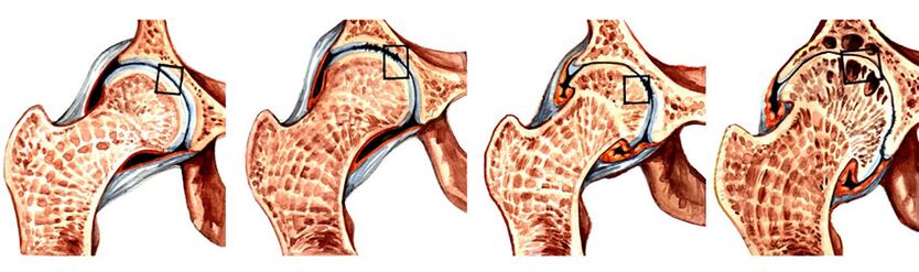 A csípőízület arthrosisának fejlettségi foka