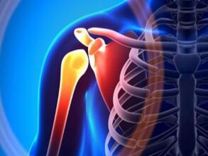 Gyulladt vállízület az arthrosis miatt - a mozgásszervi rendszer krónikus betegsége
