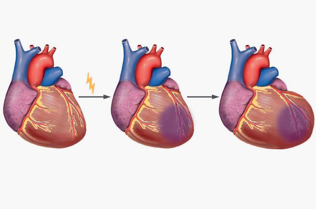 A szívinfarktus a lapockák fájdalmához vezet