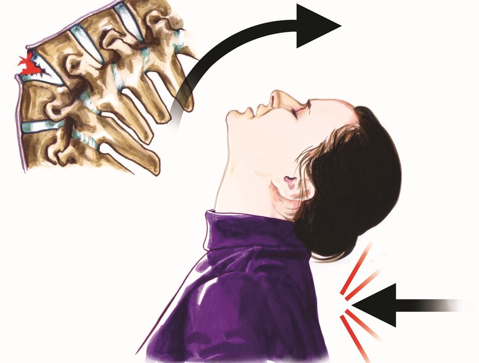 gerinckárosodás, mint a nyaki fájdalom oka