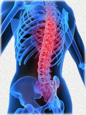 osteochondrosis és kezelési módszerek
